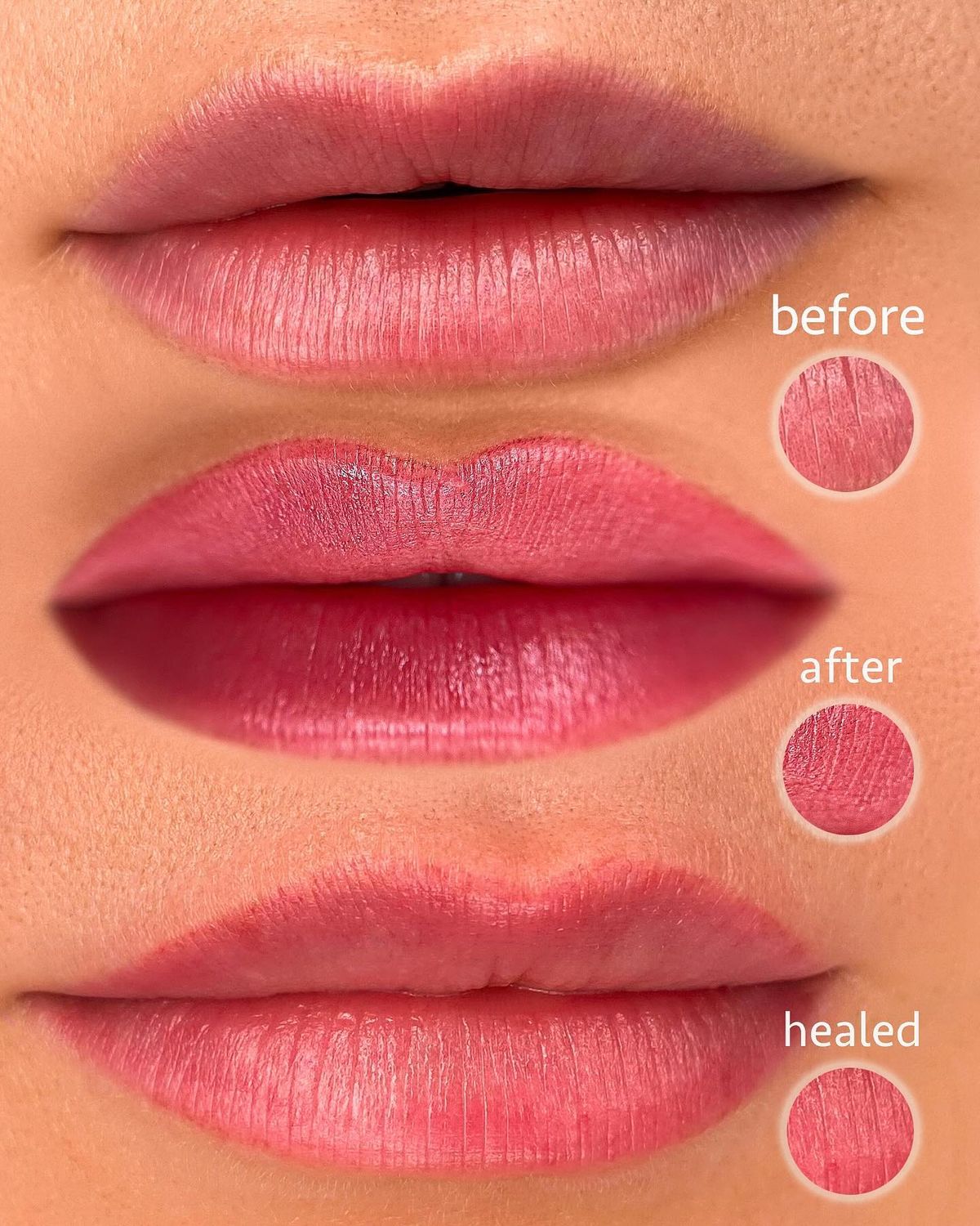 Dudak Pmu'da Renk Neden Açılır? İyileşme Sürecinin Gerçekleri